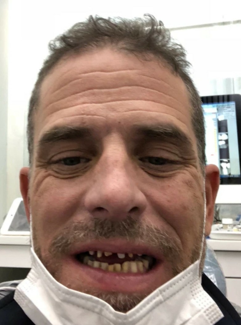 Meth head teeth pics